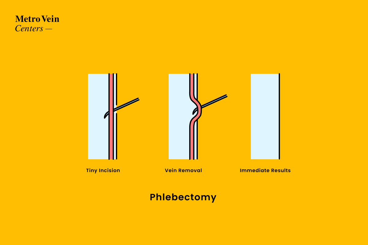 How phlebectomy treatment works www.metroveincenters.com