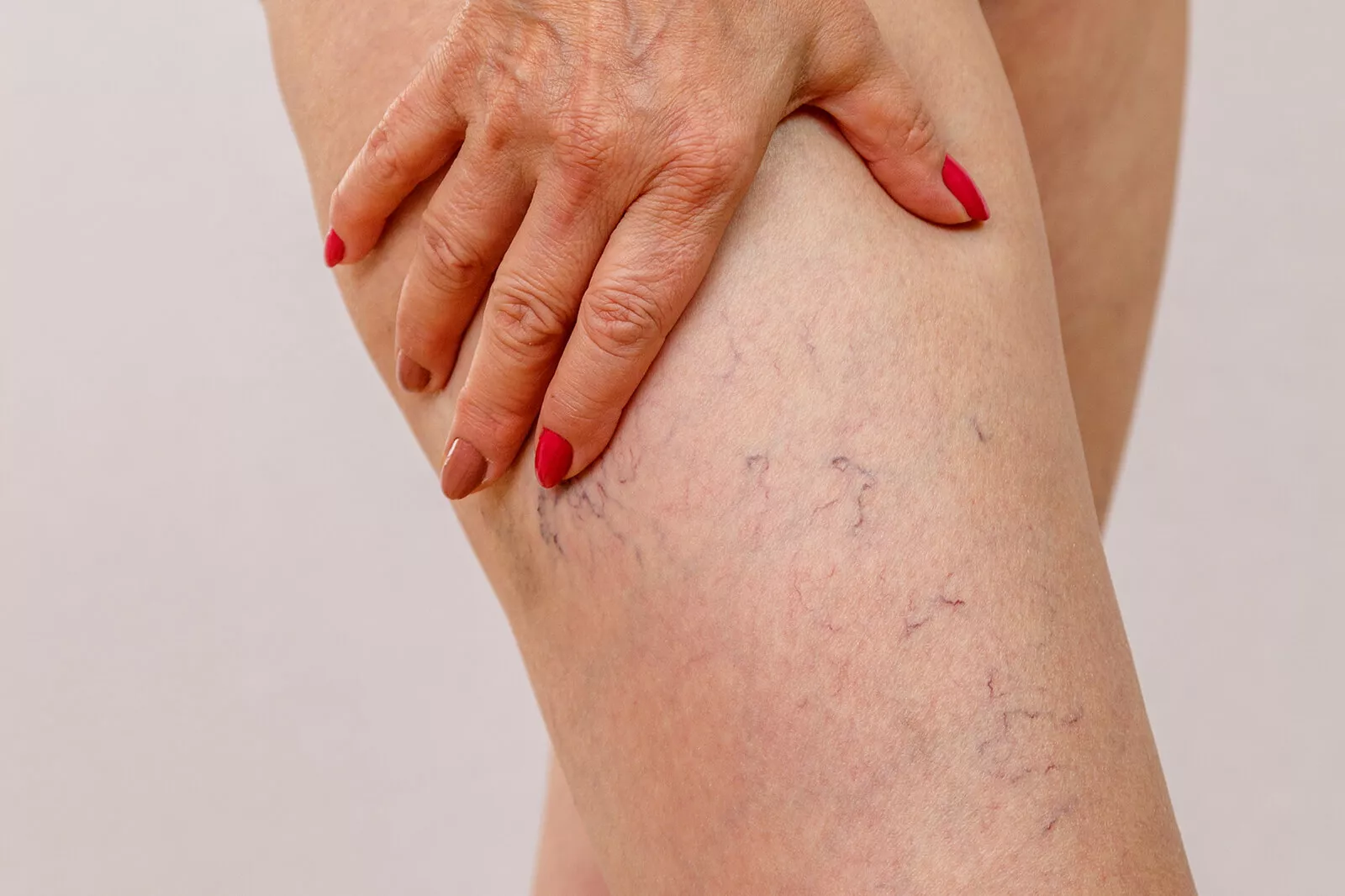 Discover why veins burst, the warning signs, and treatment options. Learn how to prevent complications and protect your vascular health.