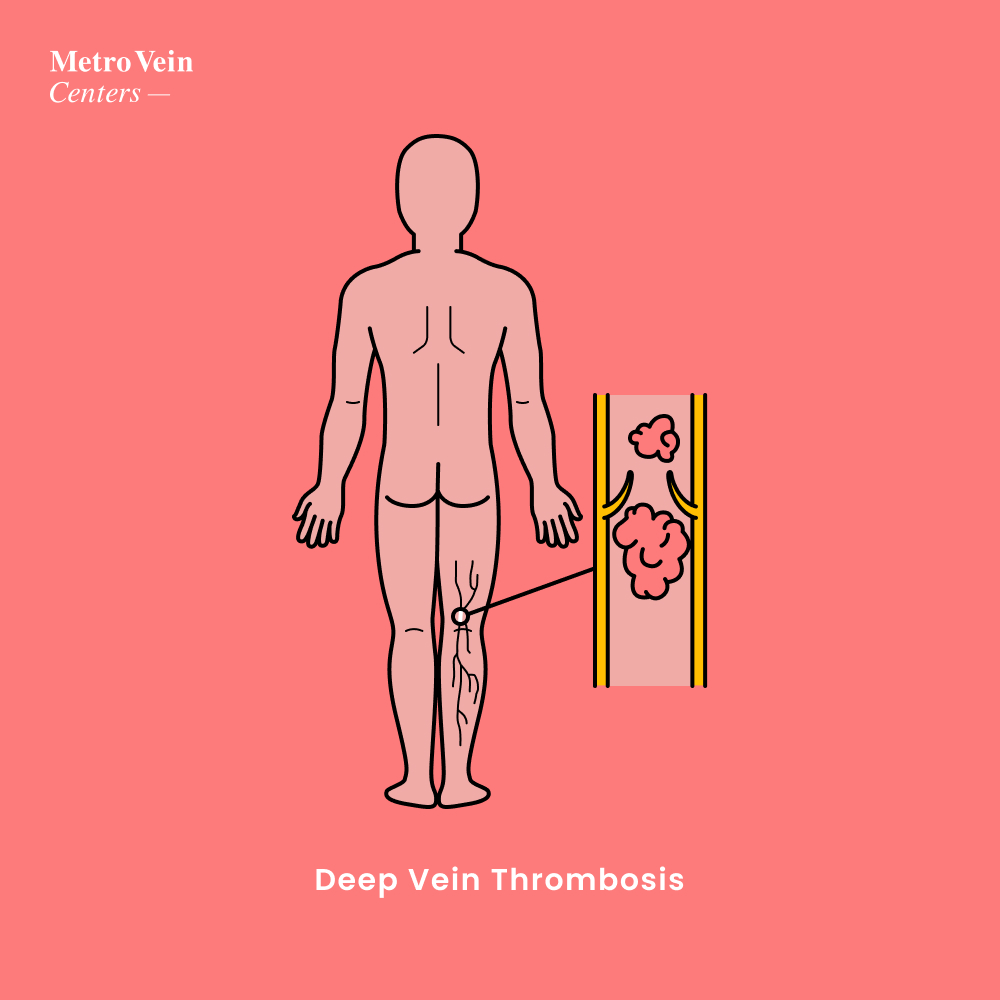 who gets a deep vein thrombosis graph metro vein centers
