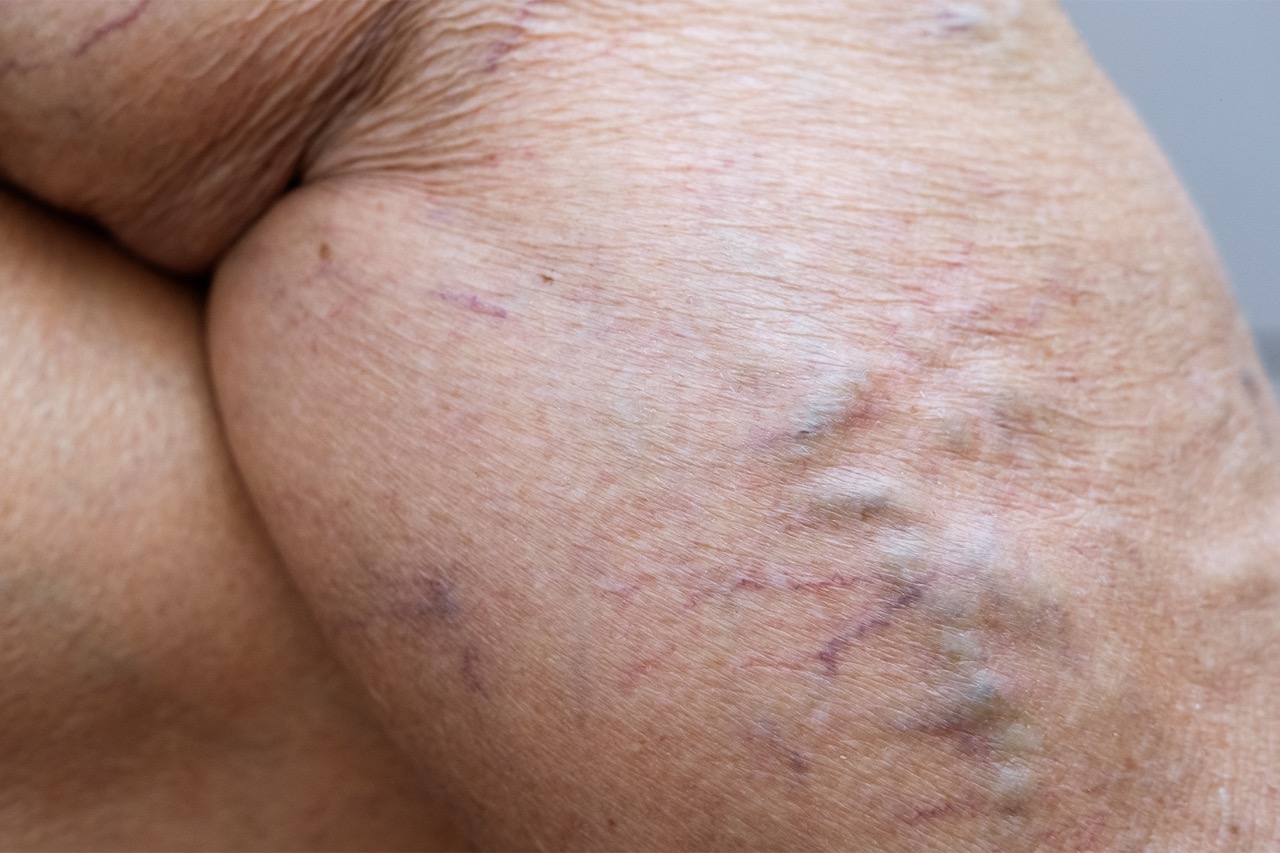 Learn how humidity affects vein health and discover practical strategies to prevent swelling, reduce discomfort, and maintain healthy circulation in hot, humid environments.