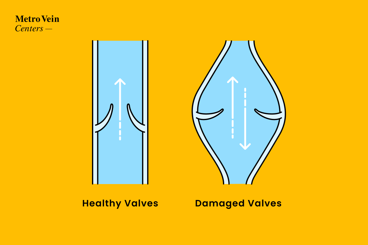 weak valves healthy valves in veins of leg graph