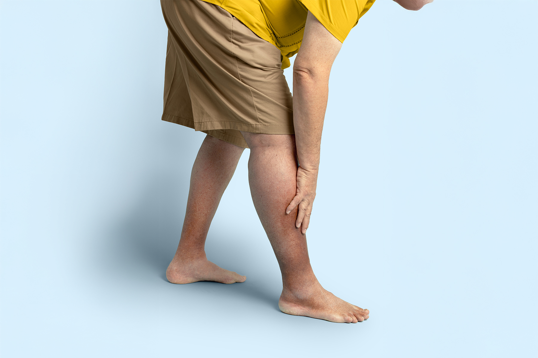 President Trump&rsquo;s chronic venous insufficiency (CVI) diagnosis explained: symptoms, causes, and modern treatments for this common, treatable vein disease.