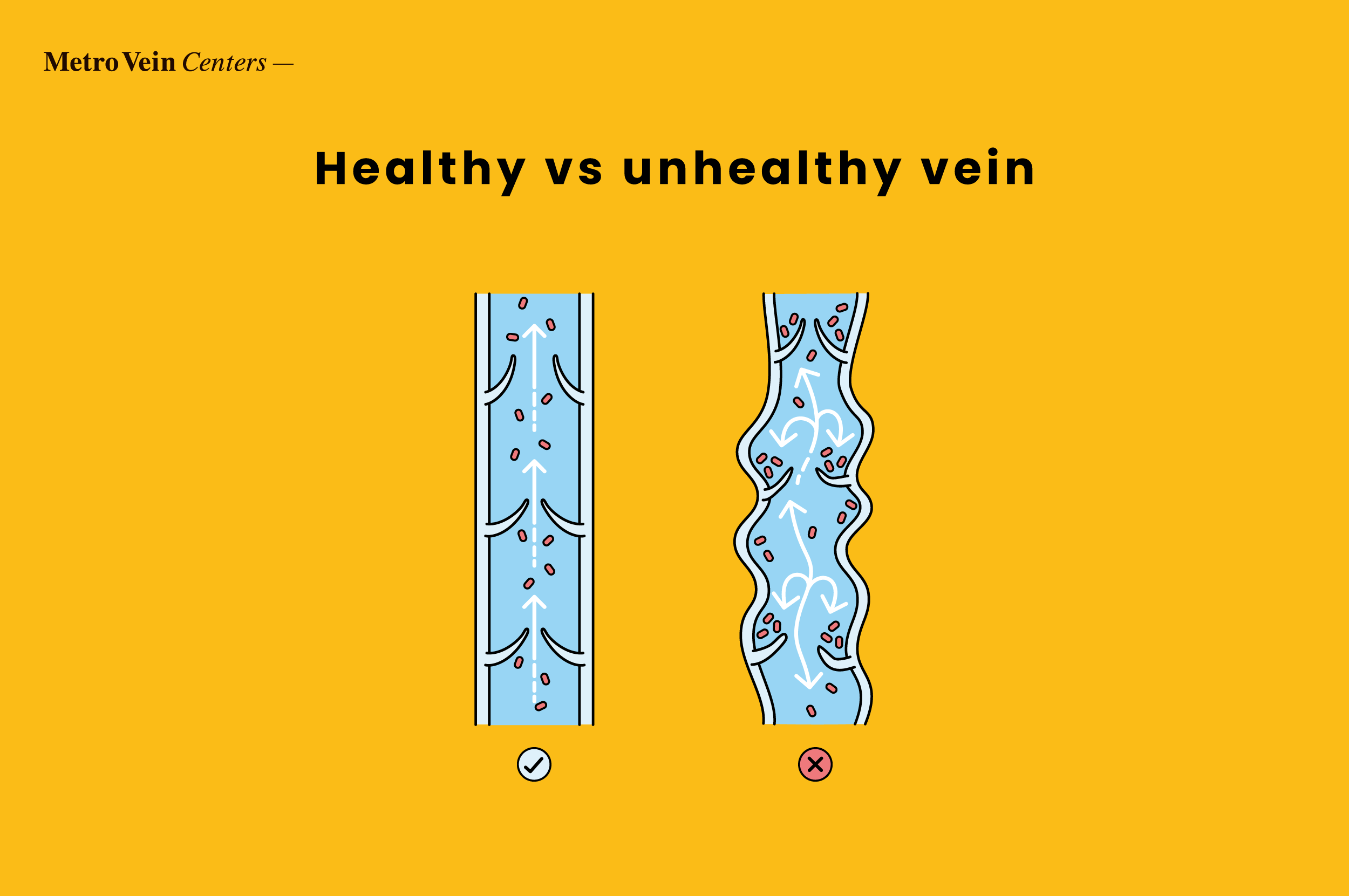 Explore venous reflux disease, its causes, symptoms, and treatment options. Learn how to manage this condition for healthier, pain-free legs.