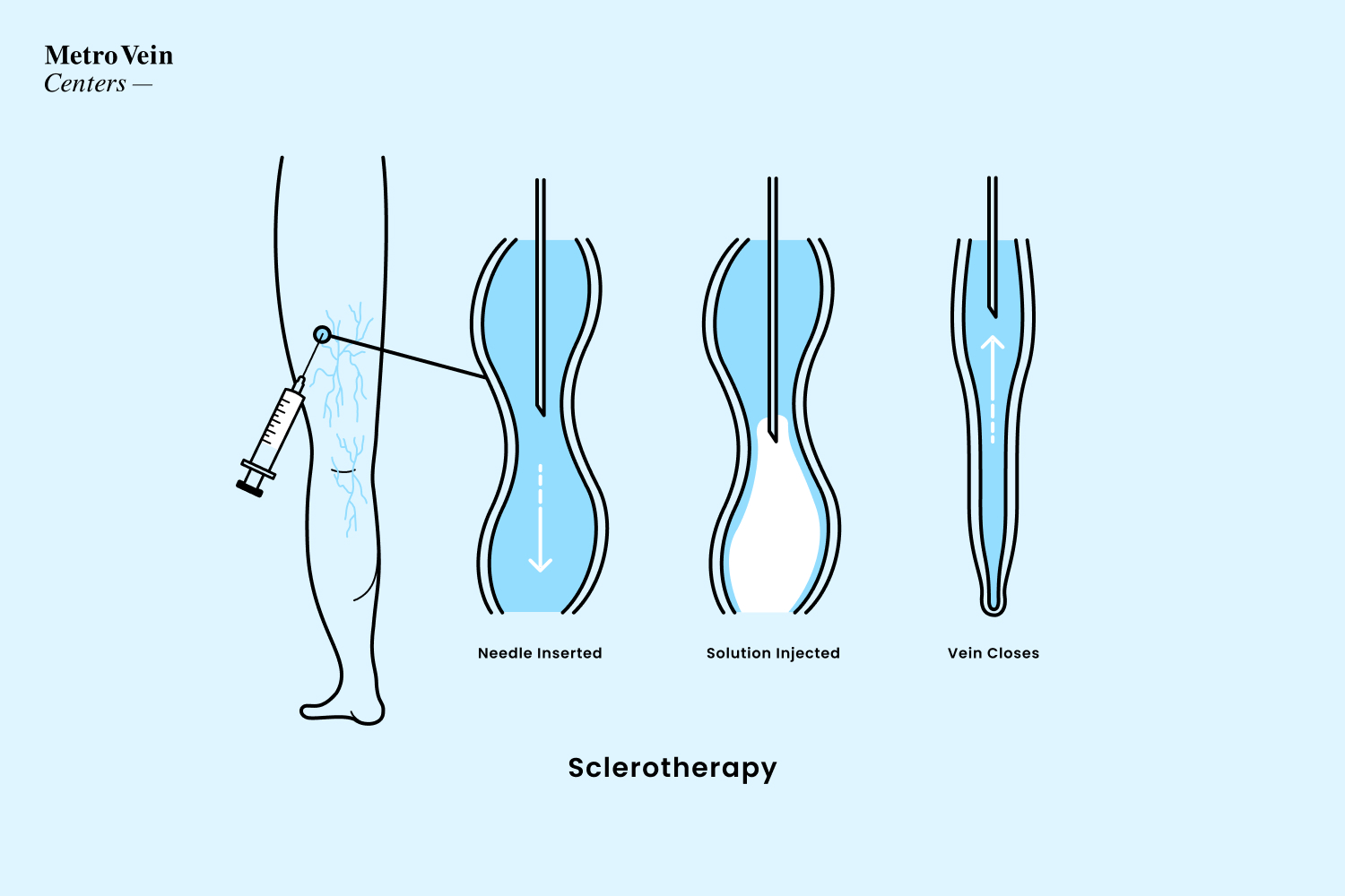 Illustration showing how sclerotherapy treatment works on leg veins.