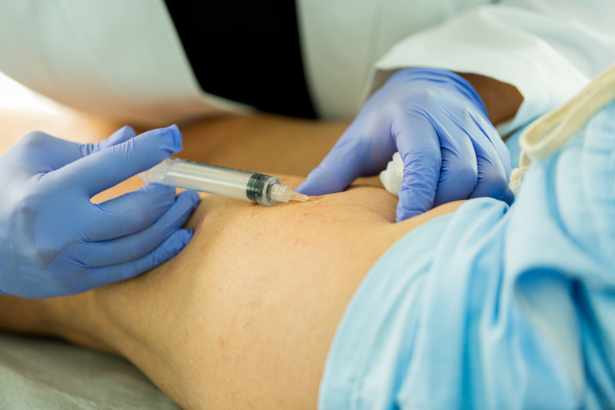 Vein specialist injecting sclerotherapy solution during vein treatment