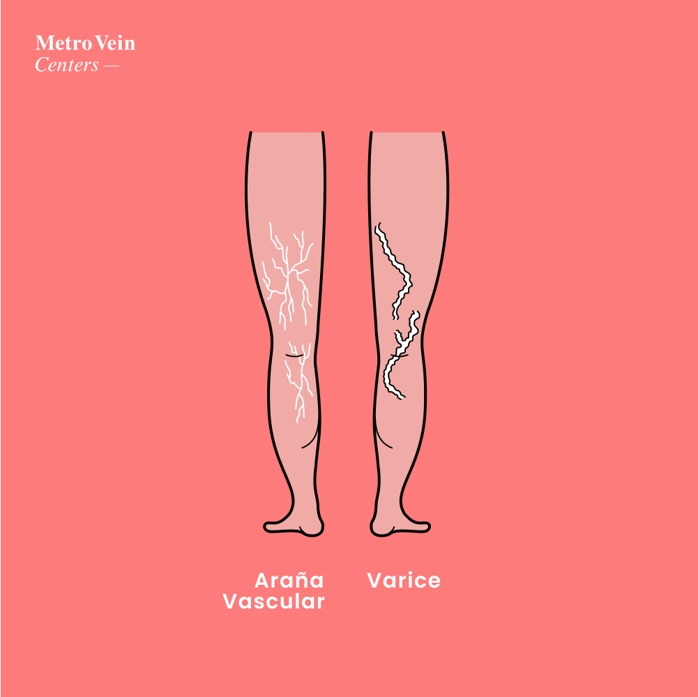 &iquest;Es la escleroterapia adecuada para tus venas? Descubre 4 cosas esenciales: duraci&oacute;n, efectos secundarios, recuperaci&oacute;n y resultados reales. &iexcl;Inf&oacute;rmate en Metro Vein Centers!