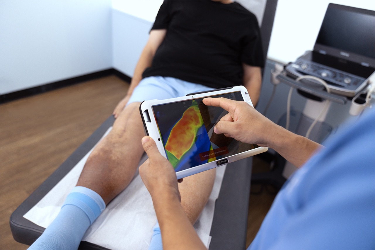 Descubre el futuro de los tratamientos venosos y los avances en la atenci&oacute;n m&eacute;dica. Explora tecnolog&iacute;as innovadoras como HIFU, procedimientos asistidos por robots, nanotecnolog&iacute;a y planes de tratamiento personalizados impulsados por IA. Aprende c&oacute;mo los conocimientos gen&eacute;ticos y las t&eacute;cnicas m&iacute;nimamente invasivas mejoradas est&aacute;n revolucionando el cuidado venoso para una recuperaci&oacute;n m&aacute;s r&aacute;pida, menos molestias y estrategias de prevenci&oacute;n dirigidas. Mantente informado sobre las innovaciones que est&aacute;n transformando la salud vascular.