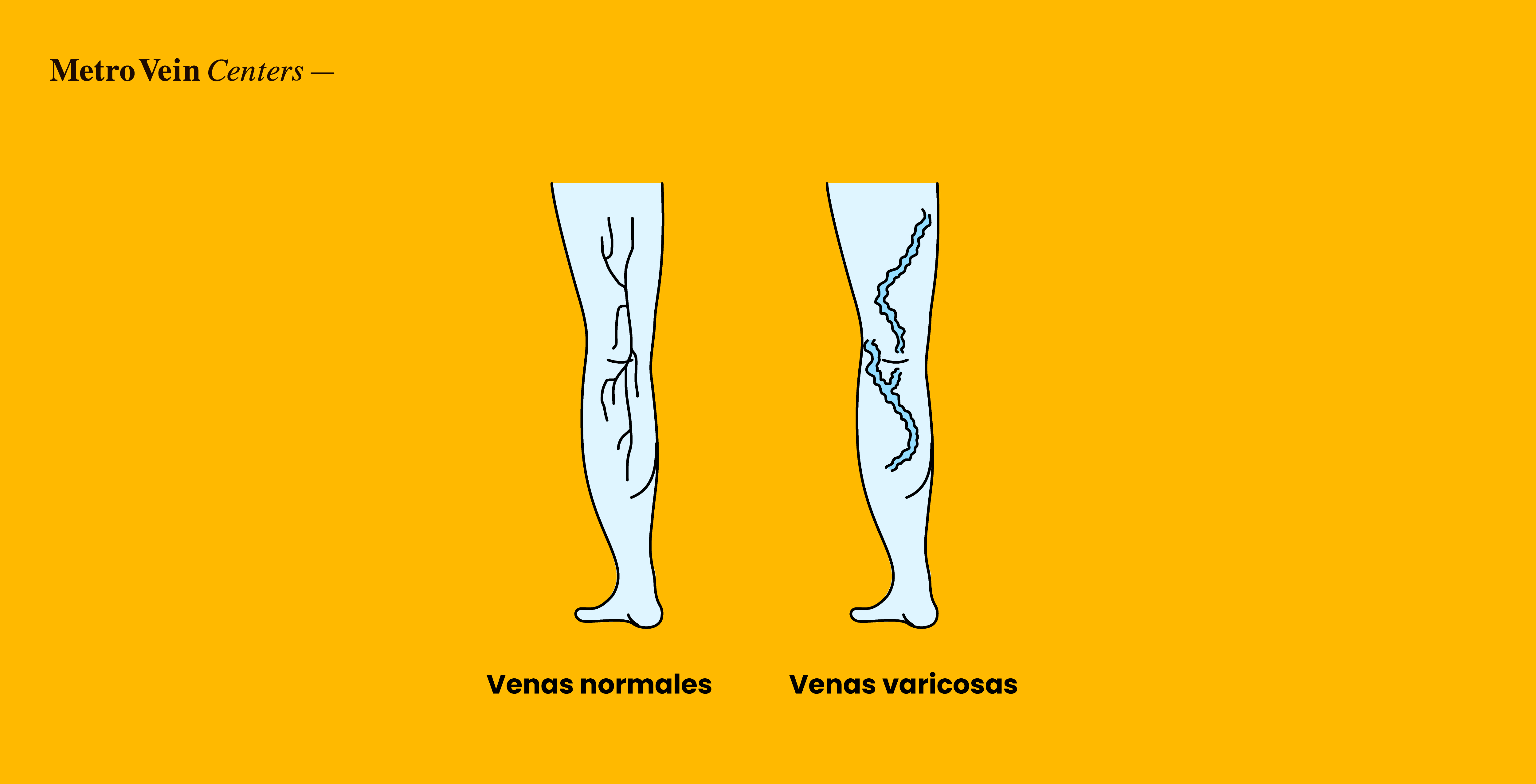 Descubra c&oacute;mo se relacionan el linfedema y las varices, en qu&eacute; se diferencian, qu&eacute; factores de riesgo comparten y cu&aacute;ndo consultar a un especialista en venas.