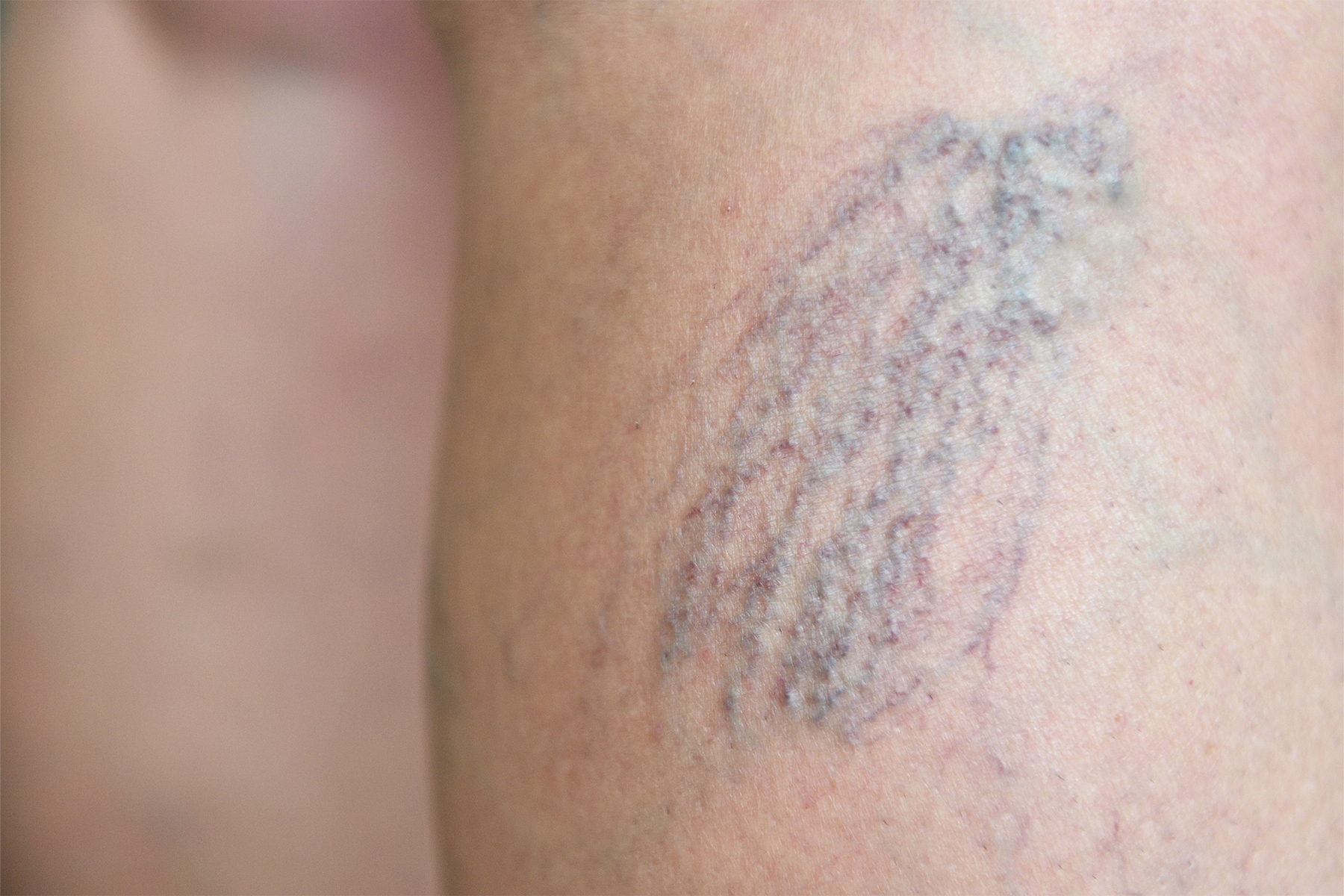 Descubra consejos de expertos para mantener las venas de las piernas sanas, prevenir las venas varicosas y conocer opciones de tratamiento dise&ntilde;adas espec&iacute;ficamente para la salud vascular de las mujeres.