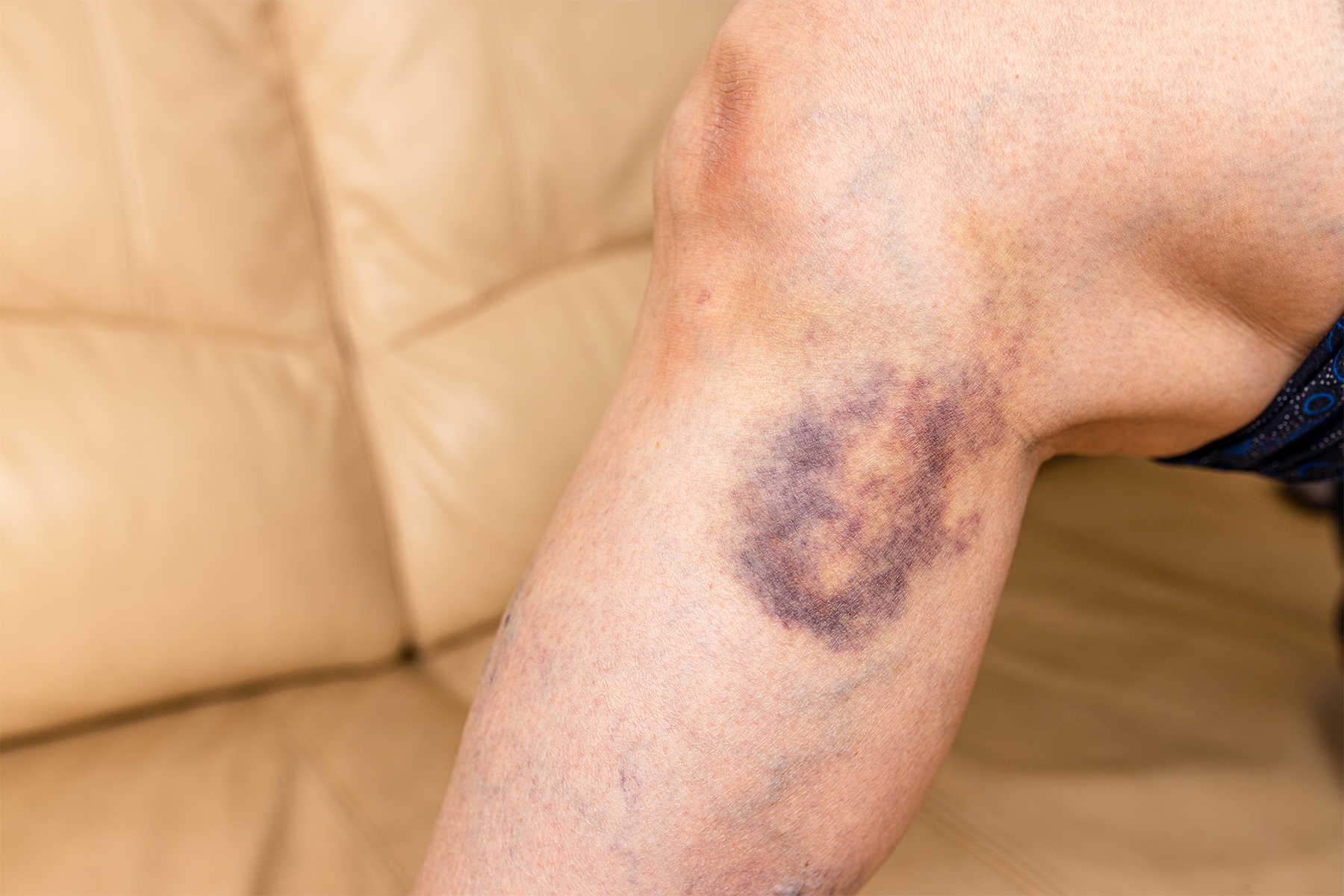 Aprenda a manejar eficazmente los efectos secundarios comunes de los tratamientos venosos. Descubra consejos de expertos para una recuperaci&oacute;n sin contratiempos y resultados &oacute;ptimos de su procedimiento venoso.