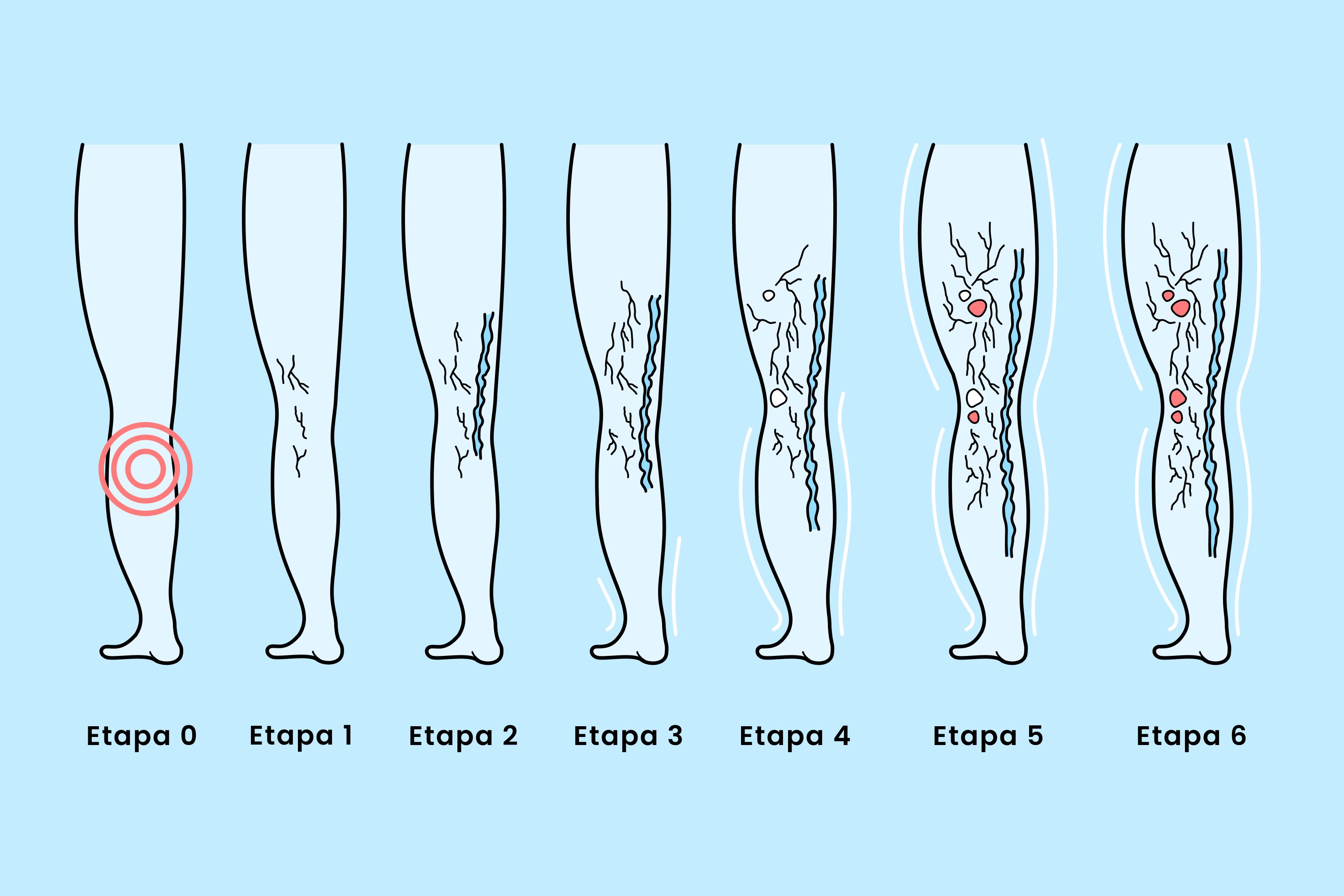 El diagn&oacute;stico de insuficiencia venosa cr&oacute;nica (IVC) del presidente Trump explicado: s&iacute;ntomas, causas y tratamientos modernos para esta com&uacute;n y tratable enfermedad venosa.