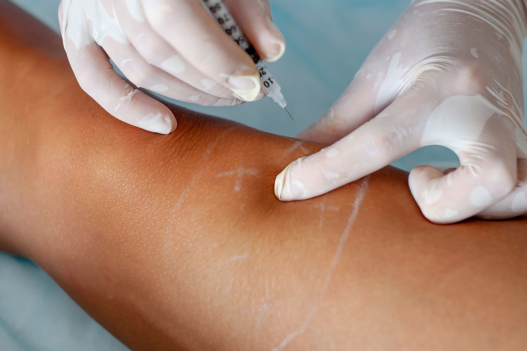 &iquest;Preocupado por la recuperacion despues de un tratamiento para las venas? &iexcl;No lo estes! Los procedimientos minimamente invasivos de Metro Vein Centers permiten una recuperacion rapida, con poco o ningun tiempo de inactividad. Descubre como acelerar la curacion y volver a tu rutina rapidamente.