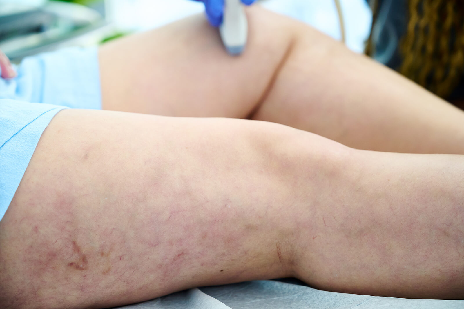 Descubre cómo ofrece la Escala de Gravedad Clínica Venosa (VCSS) a los especialistas en venas una herramienta dinámica y detallada para evaluar la gravedad de la enfermedad venosa crónica, orientar el tratamiento y monitorear el progreso del paciente a lo largo del tiempo.