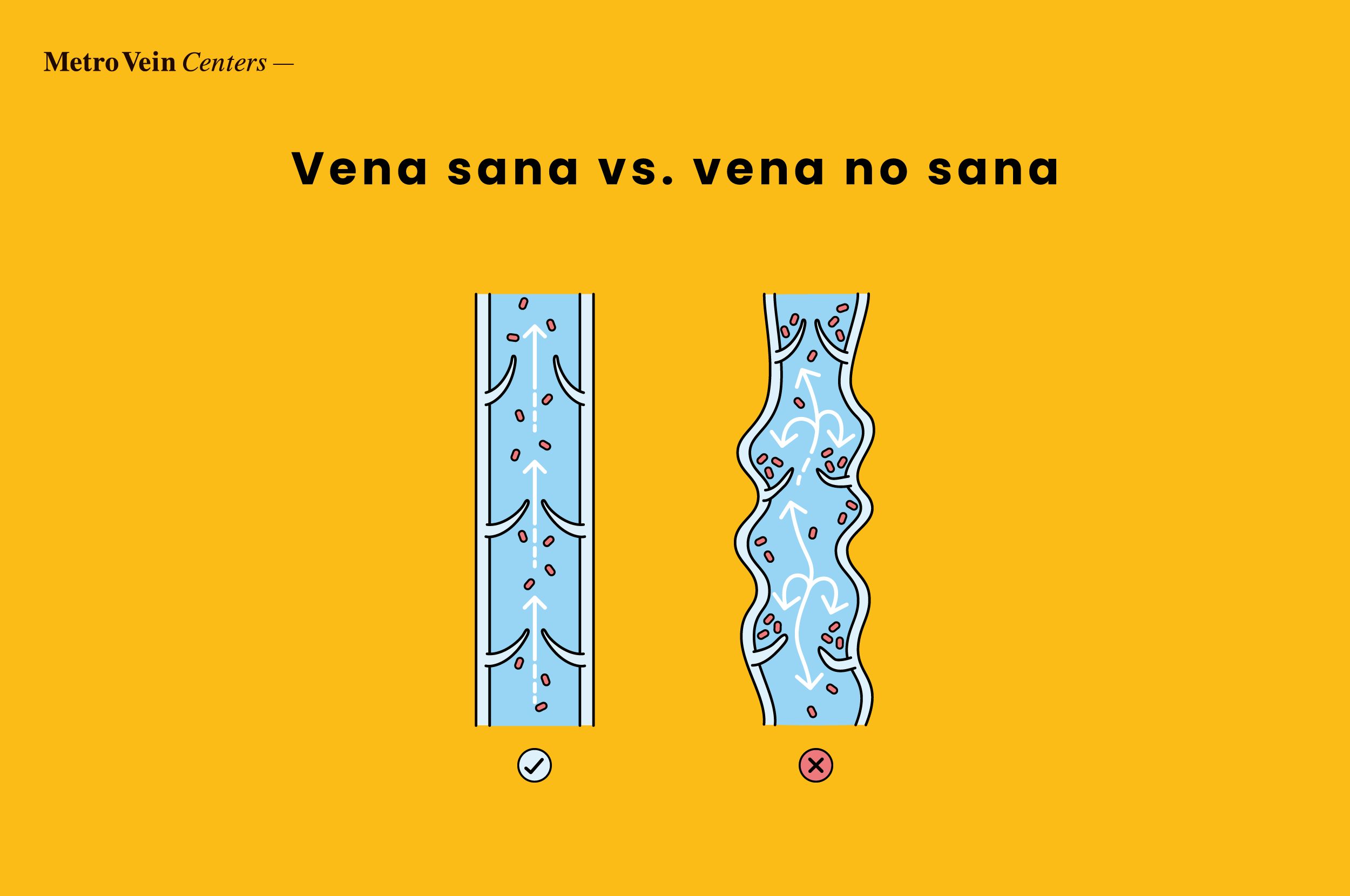 Conozca la enfermedad por reflujo venoso: causas, síntomas y opciones de tratamiento. Controle esta afección y disfrute de piernas sanas y sin dolor.